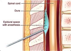 Epidural Definition & Meaning .